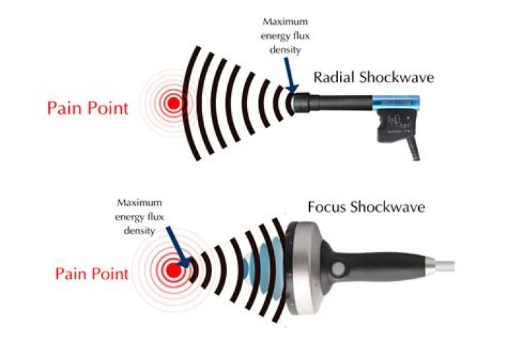 acoustic wave therapy work for ed snohomish county | Low-Intensity Extracorporeal Shock